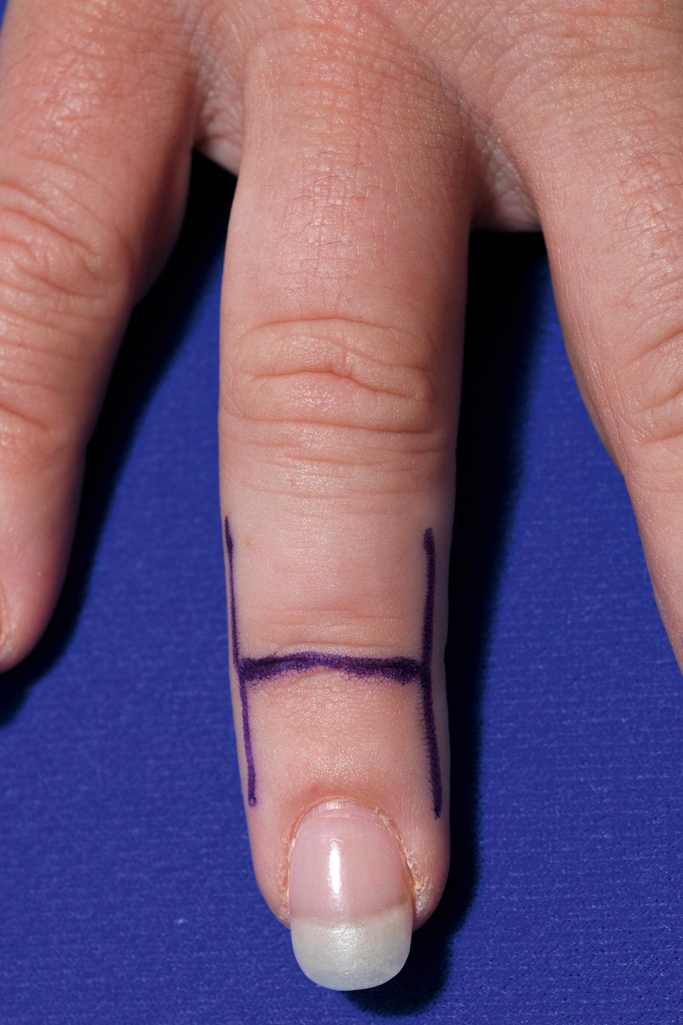 Fig. 11.4, “H” incision for arthrodesis of the distal interphalangeal joint of the finger.