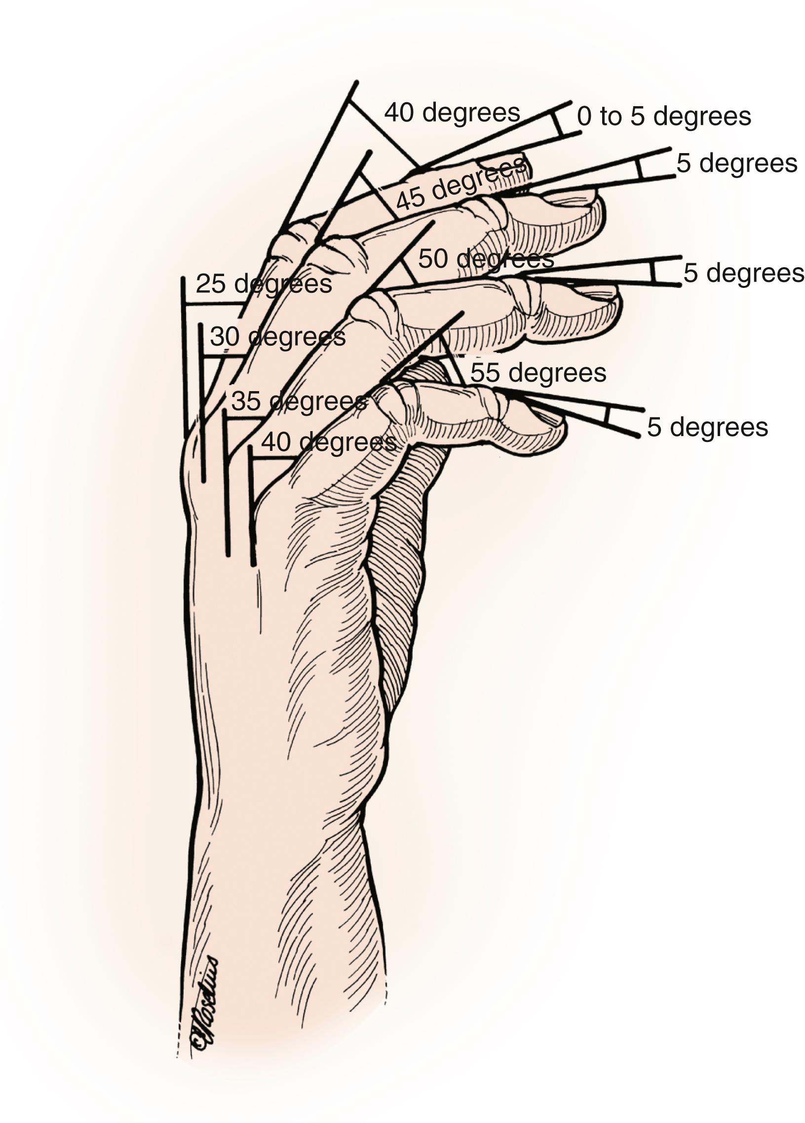 Fig. 11.6, Drawing displaying the progressive degree of proximal interphalangeal joint arthrodesis flexion.