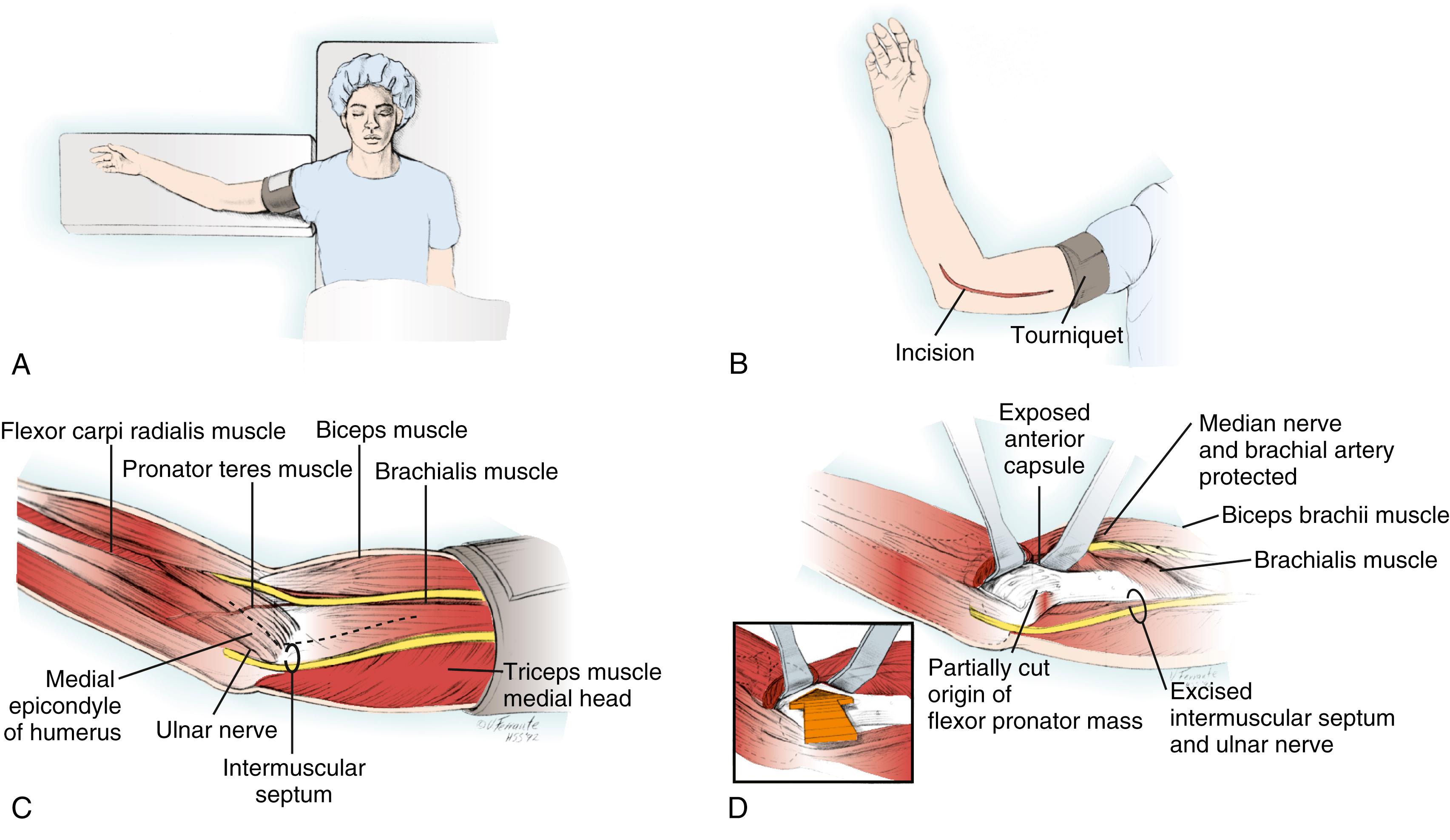 Fig. 24.3, Medial “over-the-top” approach. A, The supine position is the most useful. Two folded towels should be placed under the ipsilateral scapula. B, The skin incision may vary according to previous incisions. If the incision is made along the posterior surface, larger flaps are needed. C, The intermuscular septum should be recognized as a landmark and excised for adequate mobilization of the ulnar nerve. D, The anterior capsule is first exposed by splitting fibers between the flexor carpi ulnaris and the pronator. The anterior portion of the medial collateral ligament is protected. E, Once exposed, the capsule is sharply excised. Anterior heterotopic ossification arising from the coronoid is usually excised at this point. F, The ulnar nerve is carefully mobilized and moved forward. G, The posterior surface is exposed for excision of the capsule and heterotopic ossification. H, The tip of the olecranon is removed to clear the posterior fossa. I, The ulnar nerve is left in the anteriorly transposed position. A fascial sling or subcutaneous fat sling can be fashioned to hold the nerve anteriorly transposed without constriction.