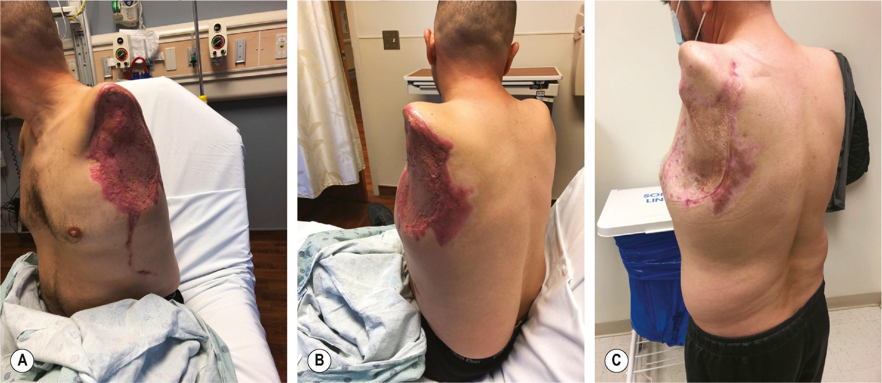 Figure 40.1, (A,B) Patient with a traumatic shoulder disarticulation amputation with painful, unstable scar and skin grafting in the shoulder and axilla that prevent prosthesis wear. (C) After tissue expansion and advancement flap of the soft tissues over the acromion and scapular spine to facilitate prosthesis suspension.