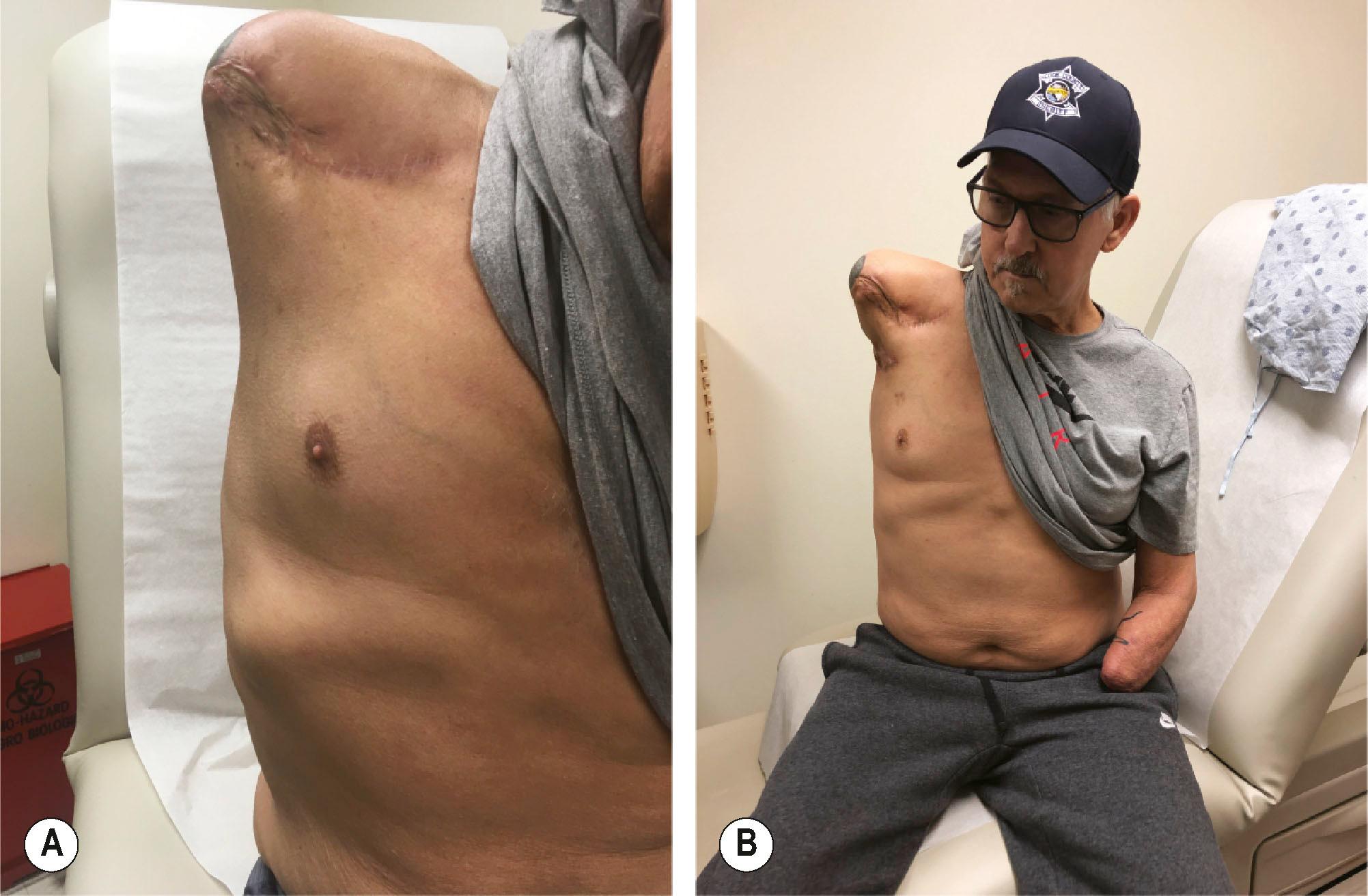 Figure 40.2, (A) Patient with a shoulder disarticulation amputation has difficulty with prosthesis suspension. (B) After a pedicled parascapular flap has been used to deepen the soft tissue indentation in the right axilla to functionally “lengthen” his residual shoulder, promoting improved prosthesis suspension.