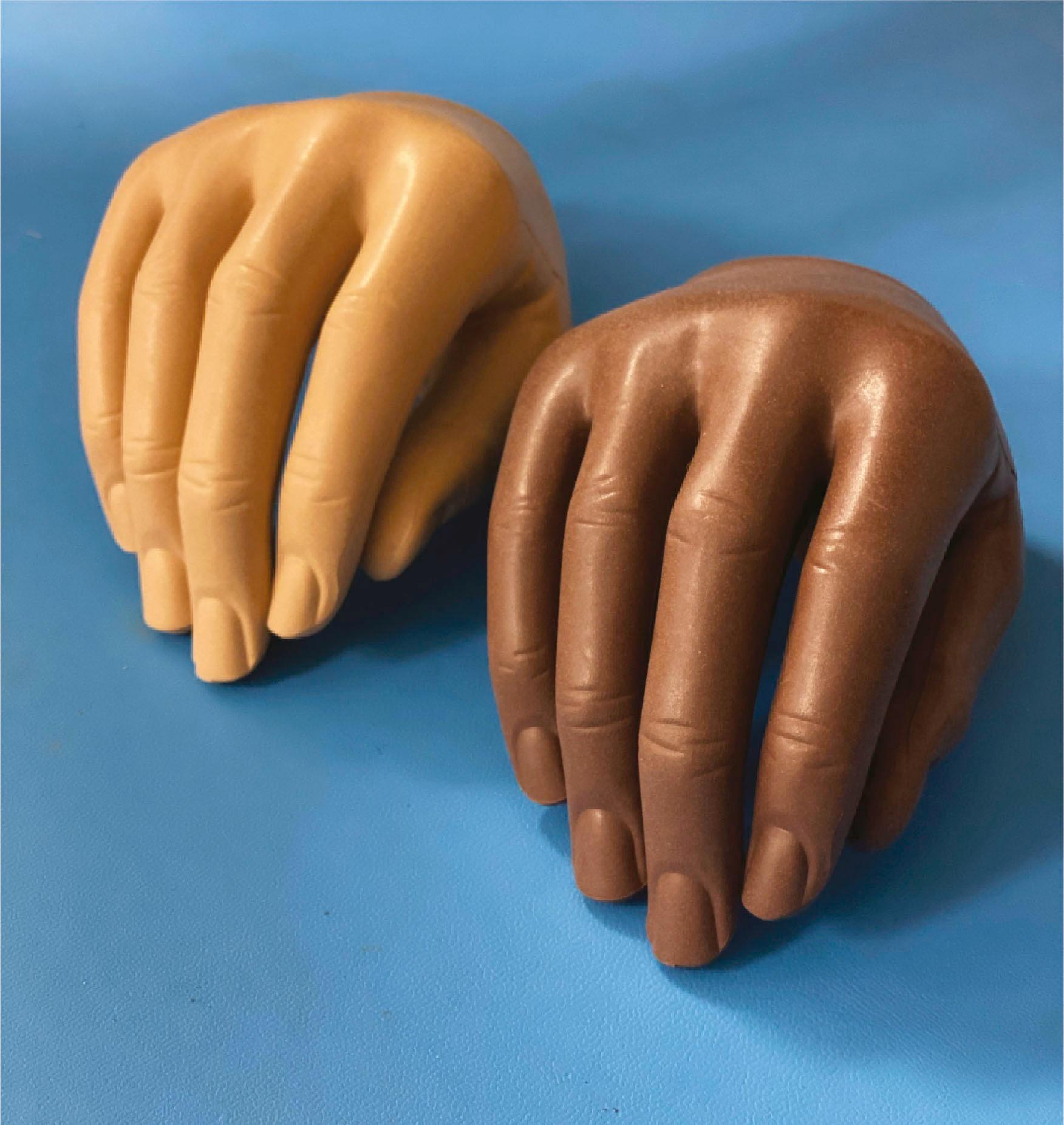 Figure 40.3, Multiple digit prostheses for cosmesis.