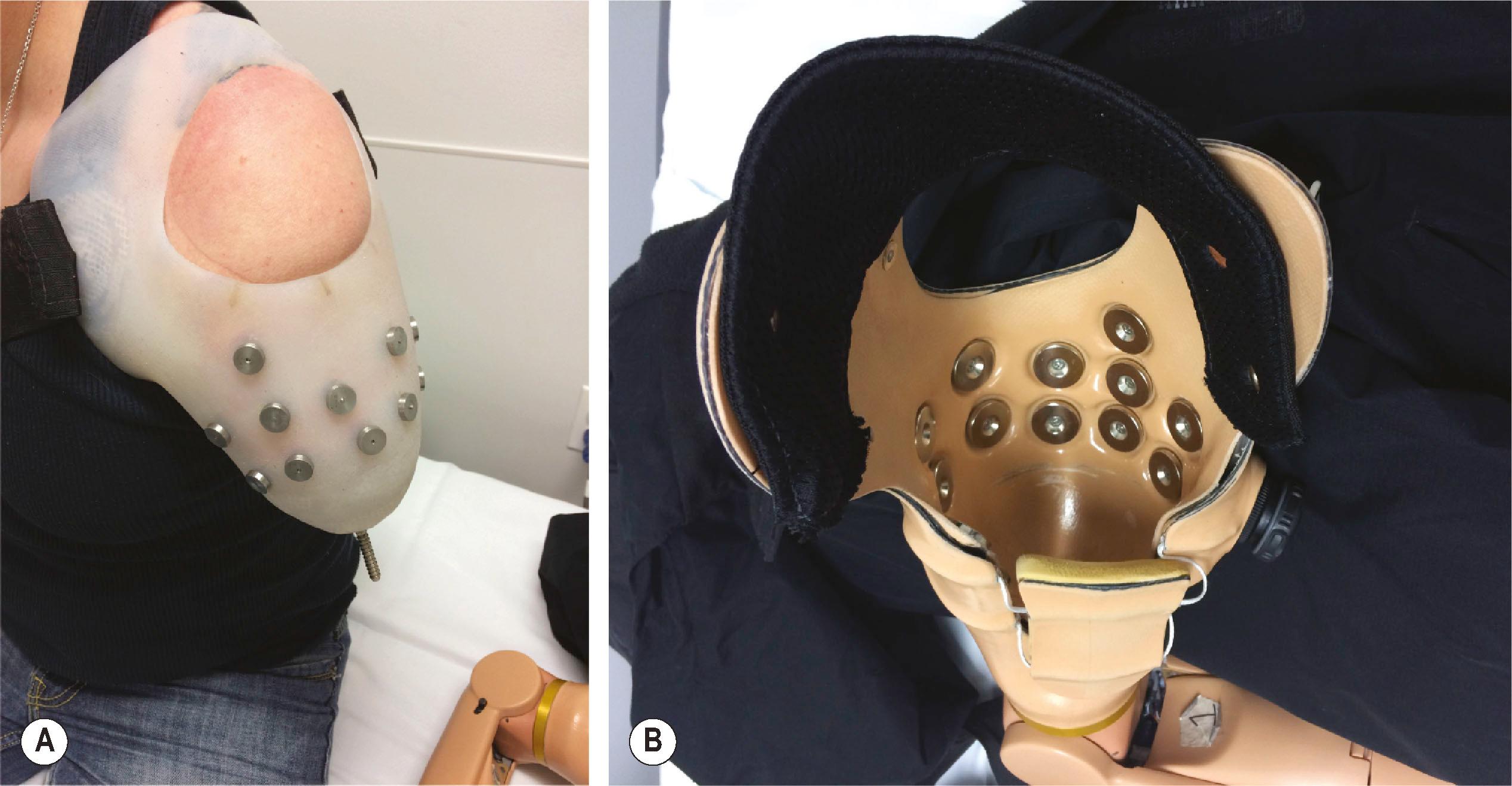 Figure 40.4, In order for surface sensors to accurately record EMG signals, there must be a very tight socket fit. (A) A transhumeral socket with embedded electrodes. (B) The socket of this transhumeral myoelectric prosthesis has matching electrodes with pattern recognition capabilities.