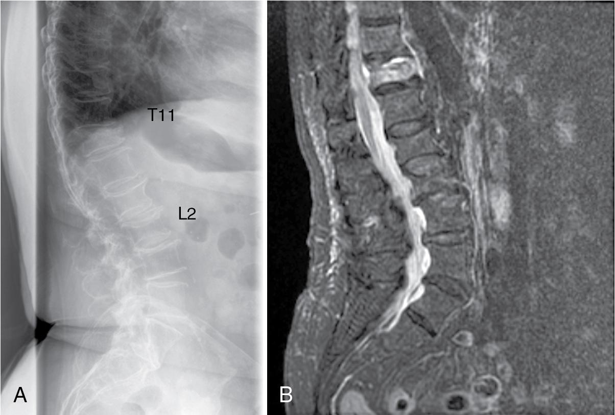 Fig. 65.1, (A) Lateral radiograph demonstrates fractures of T11 and L2 in an elderly woman with acute onset of thoracolumbar pain. (B) T2 sequence magnetic resonance imaging shows increased signal in T11, while the L2 body has no increased signal compared with the surrounding vertebral bodies. This signifies the T11 fracture as acute and the L2 fracture as chronic and healed.