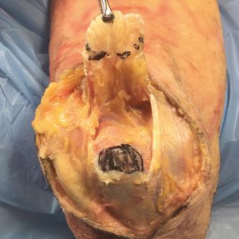 Fig. 31.1, Anteroposterior photograph of a cadaveric elbow demonstrating the broad, rectangular triceps footprint on the olecranon. Notice the footprint insertion begins approximately 12 mm distal to the tip of the olecranon and continues distally 13.4 mm on average.