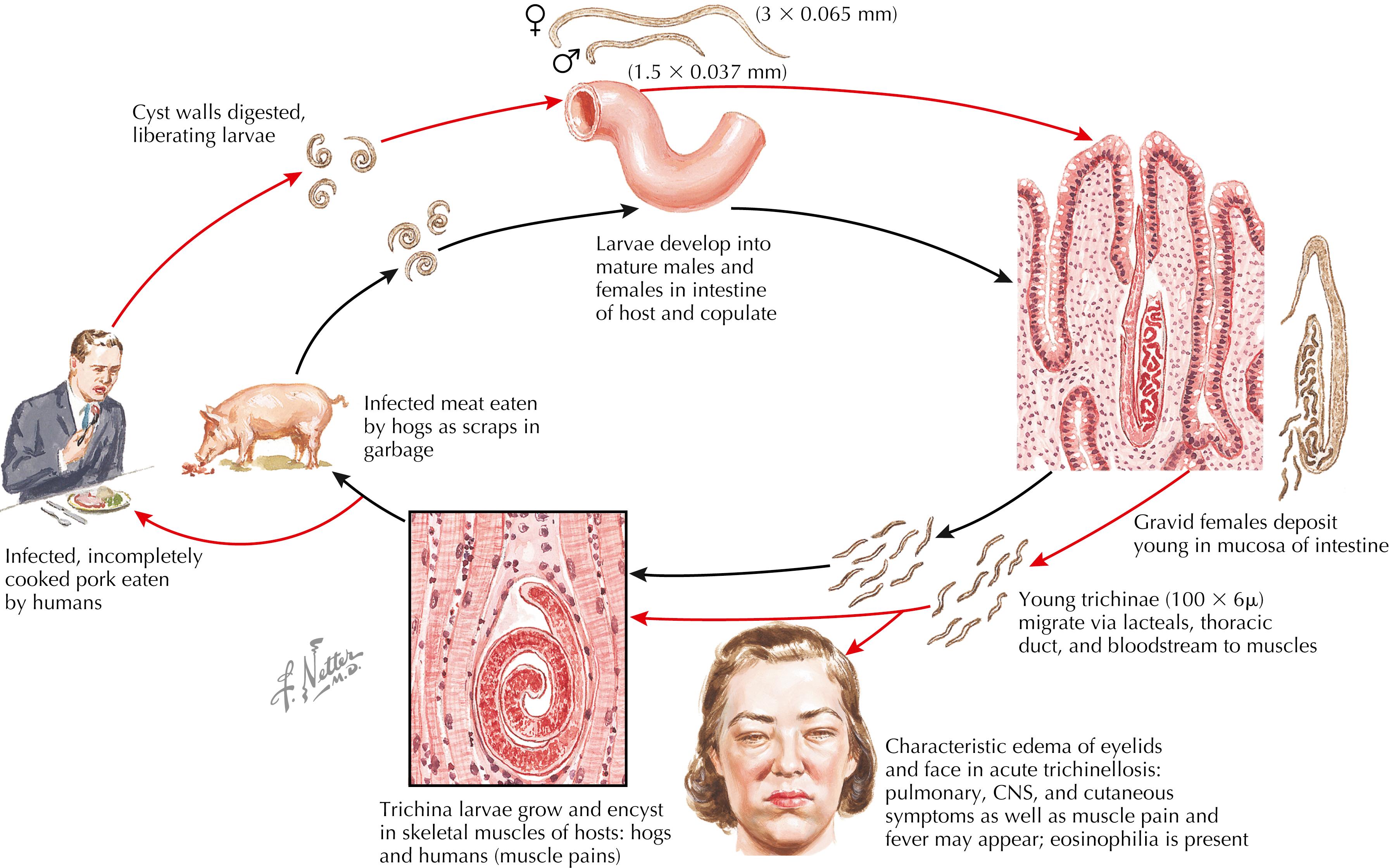 Fig. 86.1, Trichinellosis.