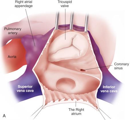 Figure 23.1, (A and B) Anatomy and relations of tricuspid valve.