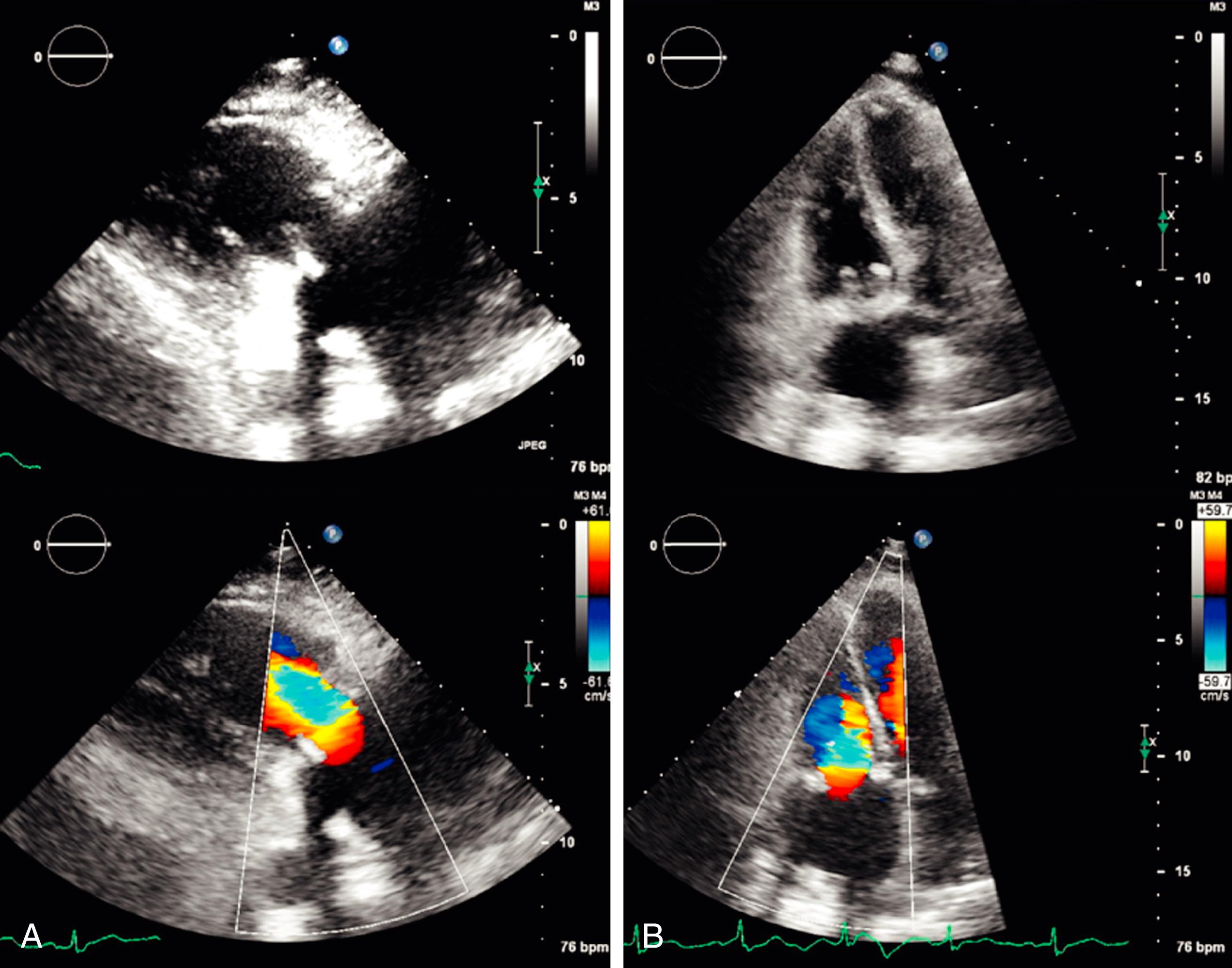 Figure 113.1, A , Two-dimensional (2D) and color-flow mapping of a normal tricuspid bioprosthesis in a 66-year-old woman from the right ventricular inflow view. B, 2D and color-flow mapping in the four-chamber view shows wide, smooth, unobstructed flow across the prosthesis. (See accompanying Video 113.1 .)