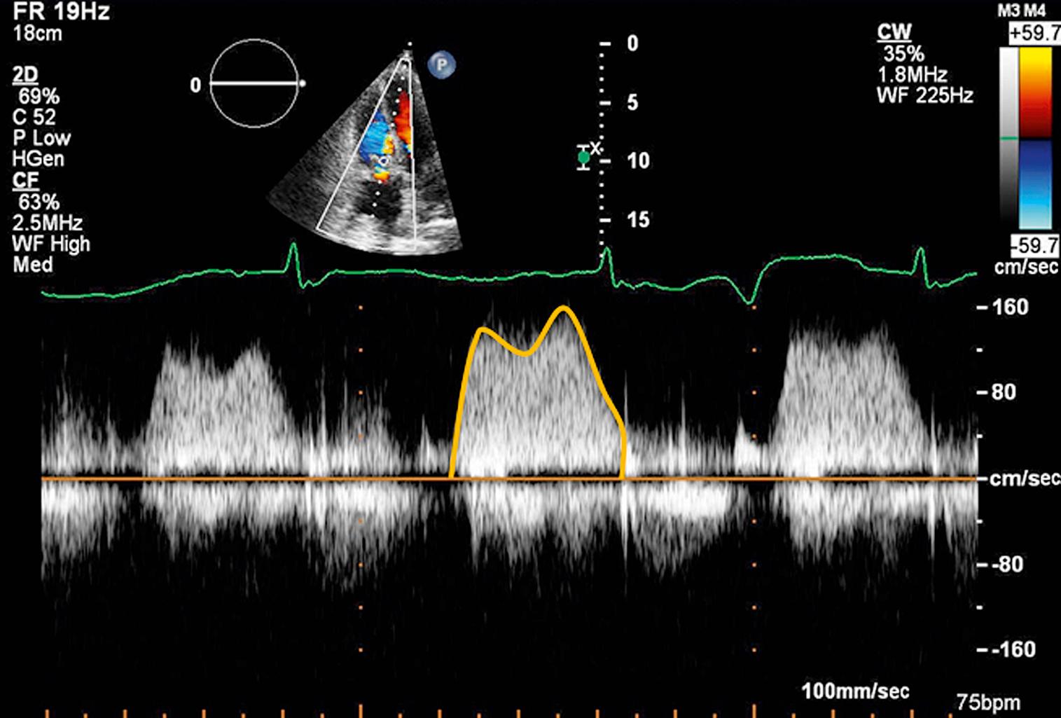 Figure 113.2, Continuous wave (CW) Doppler examination of a normal bioprosthetic tricuspid valve in the apical four-chamber view during the early postimplantation period by transthoracic echocardiography. The mean gradient was 4.8 mm Hg after averaging five cycles. (See accompanying Video 113.2 .)