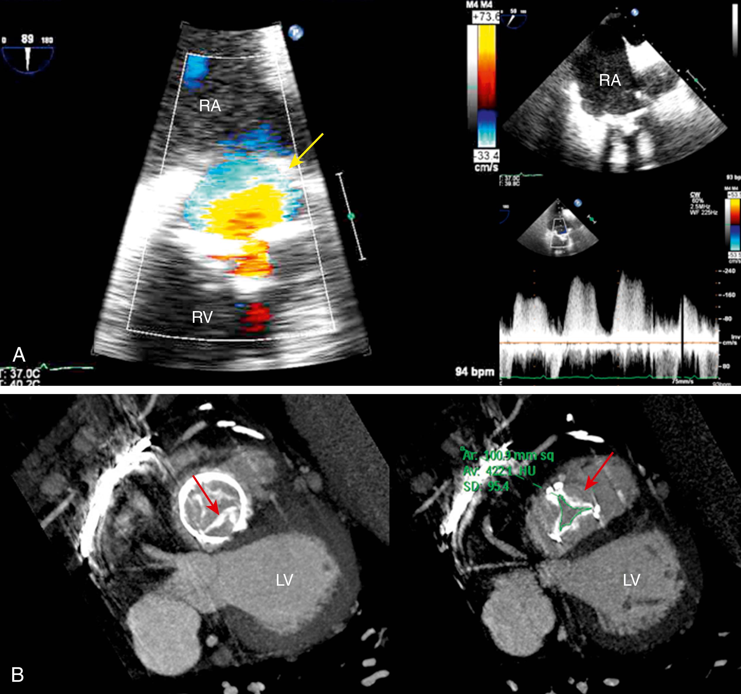 Figure 113.3, Transesophageal echocardiography images from a 40-year-old woman with severe prosthetic valve stenosis. A, The bioprosthetic tricuspid valve has severe calcification with stenosis, and color-flow mapping shows a prominent proximal isovelocity surface area (PISA) region (yellow arrow) caused by severe stenosis. B, The valve is imaged on multidetector computed tomography, which reveals the presence of degenerative and highly calcified leaflets in a short-axis view of the valve, with the anatomic area (red arrow) planimetered at 1.01 cm 2 . LV, Left ventricle; RA, right atrium; RV, right ventricle. (See accompanying Video 113.3 .)