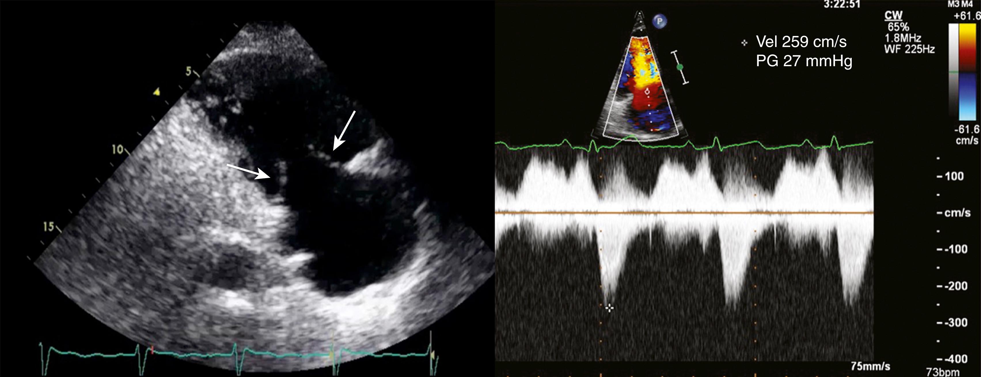 Figure 108.1, The left panel illustrates a two-dimensional echocardiographic image of a tricuspid valve (TV) in a patient with carcinoid syndrome, obtained in a right ventricular inflow view in systole. Note the frozen appearance of the tricuspid leaflets (white arrows) . The right panel shows a continuous-wave (CW) Doppler recording through the TV. Note the presence of elevated diastolic gradient with significant tricuspid regurgitation. PG, Pressure gradient; Vel, velocity. (Accompanying Video 108.1 corresponds to the left panel .)