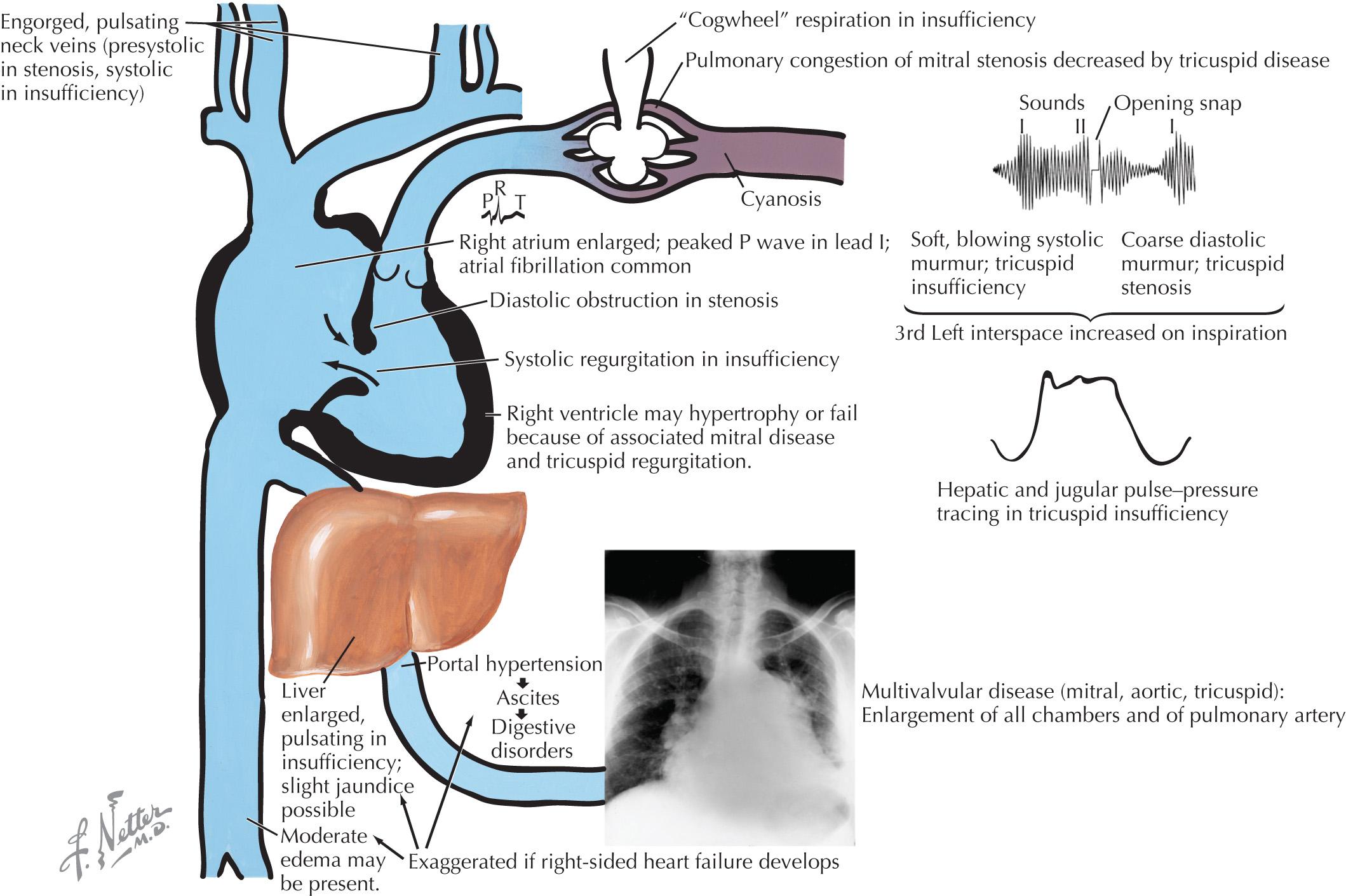 FIG 48.1, Tricuspid Stenosis and Tricuspid Insufficiency.