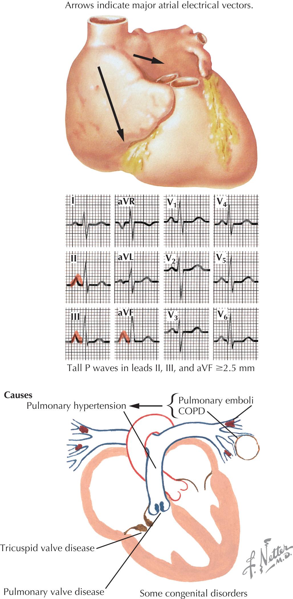 FIG 48.2, Causes of Right Atrial Enlargement.