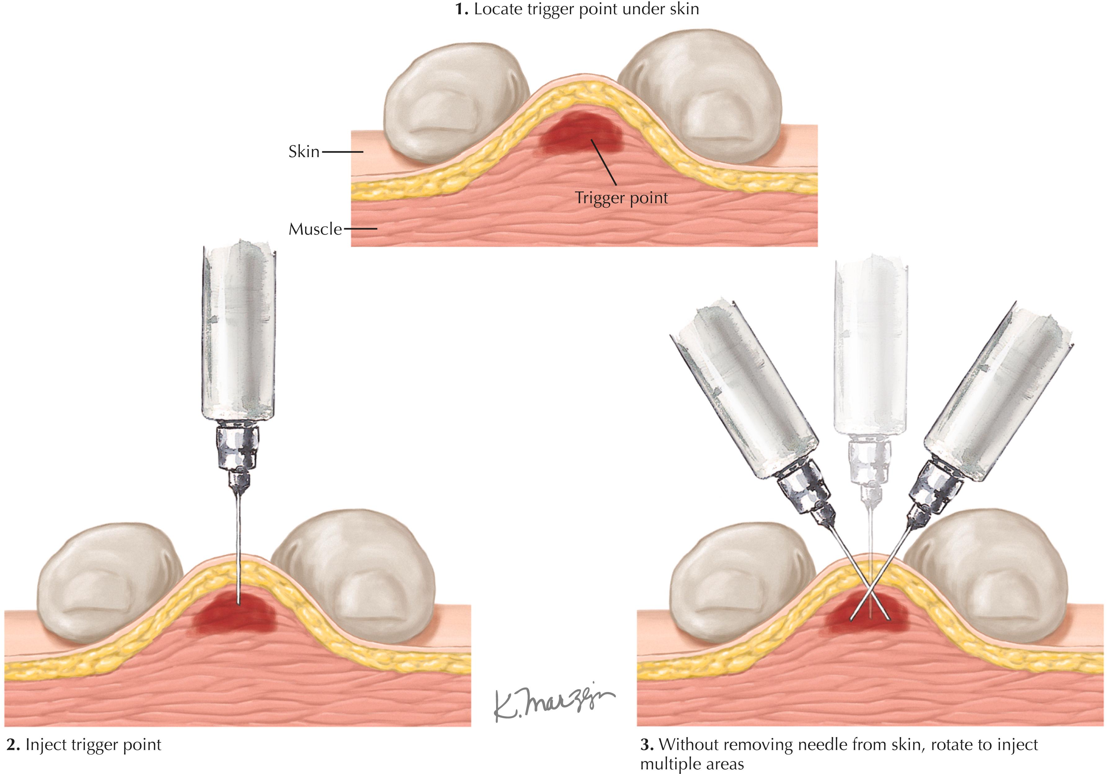 Trigger Point Injection - Clinical Tree