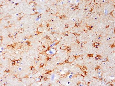 Fig 2, Huntington disease. Degeneration and loss of medium spiny neurons in the caudate and putamen is associated with marked reactive astrocytosis (glial fibrillary acidic protein [GFAP]-immunohistochemistry).