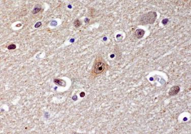 Fig 3, Huntington disease. Intranuclear inclusions of cortical and striatal neurons may be identified by immunohistochemistry for ubiquitin.