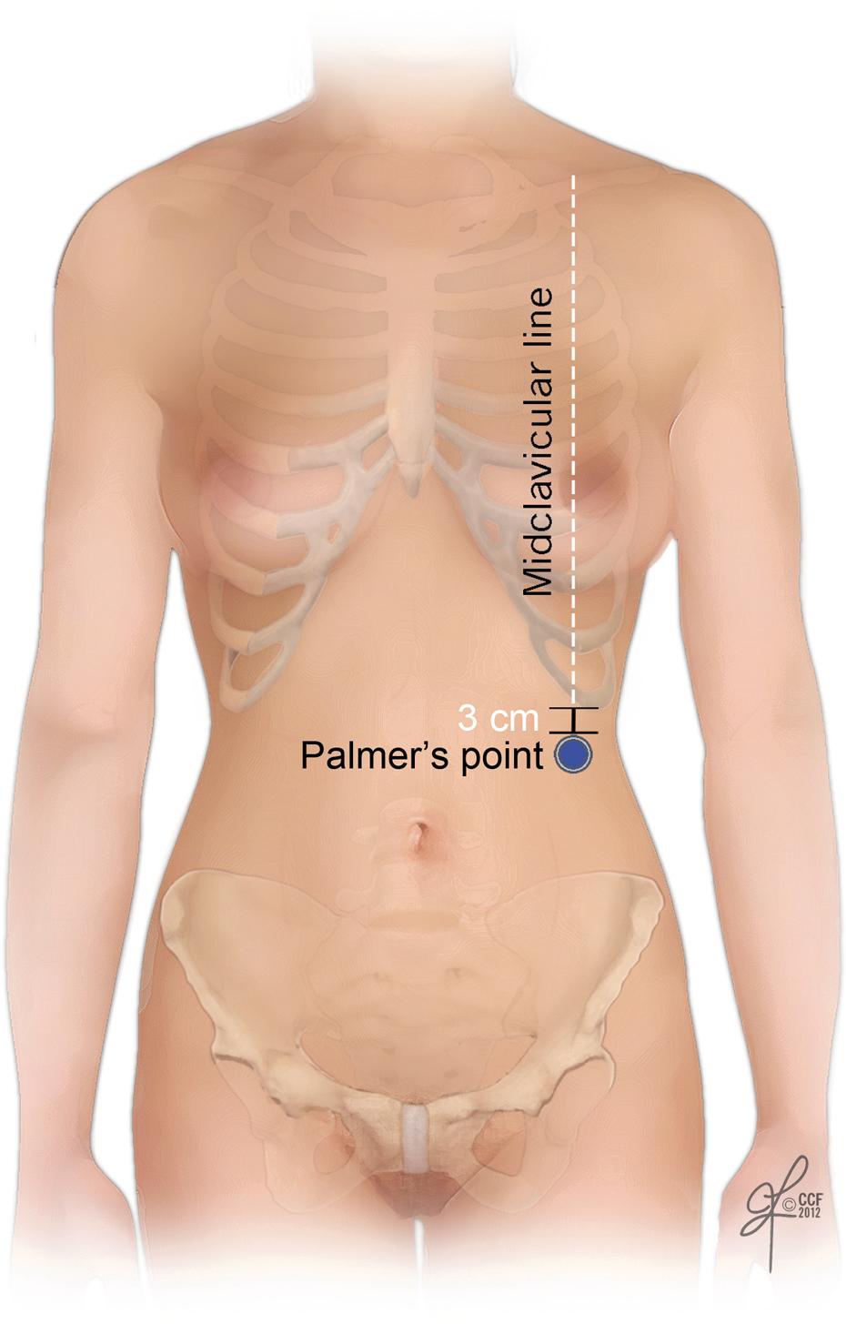 FIG. 112.1, Palmer’s point is located 3 cm below the left costal margin at the left midclavicular line.