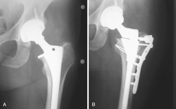 Fig. 18.1, Anteroposterior radiographs of a hip replacement with unacceptable leg lengthening (A) before and (B) after revision surgery with trochanteric osteotomy and advancement. Internal fixation using a locking plate with cable augmentation.