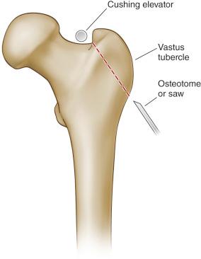 Fig. 18.2, Standard trochanteric osteotomy.