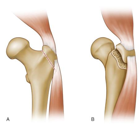 Fig. 18.4, (A and B) Anterior trochanteric slide osteotomy.