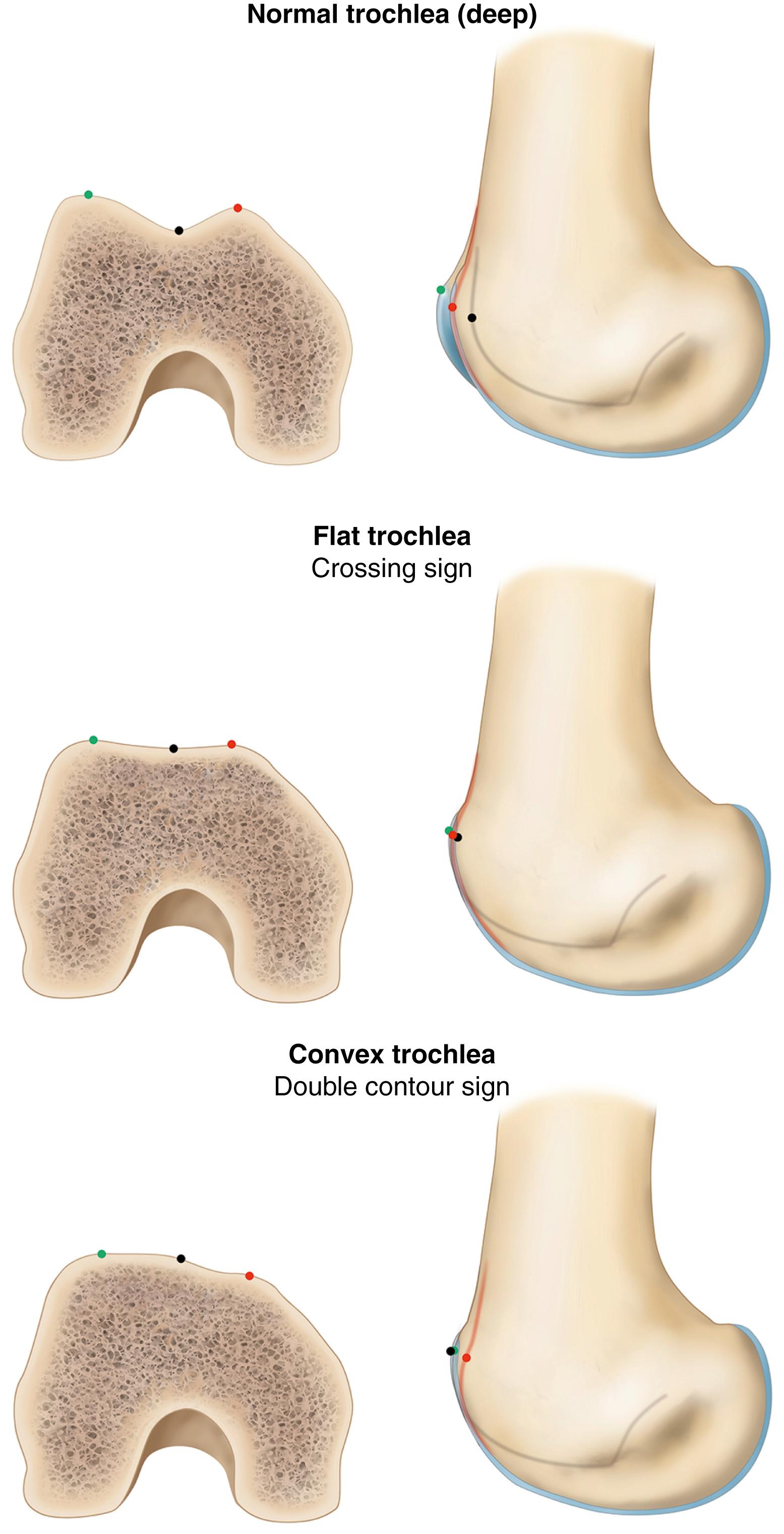 Fig. 32.1, Trochlear dysplasia characteristics.