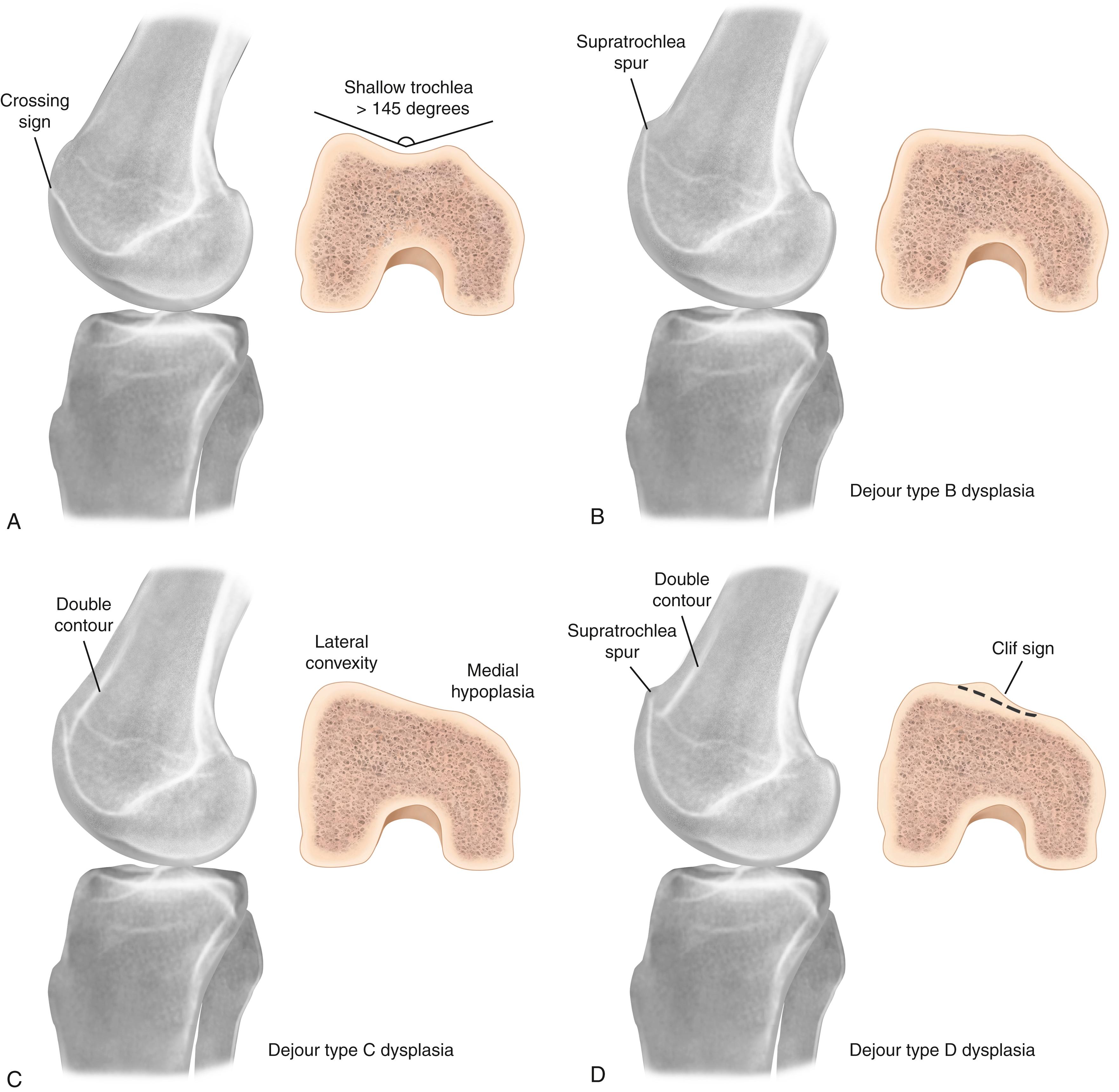 Fig. 32.2, Dejour classification system for trochlear dysplasia represented by lateral radiographic views and axial cross sections. (A) In type A dysplasia, the trochlea is shallow but still symmetrical and concave, with the crossing sign on the lateral radiograph. (B) In type B dysplasia, the trochlea is flat or convex, with the crossing sign and a trochlear spur on the lateral radiograph. (C) In type C dysplasia, the lateral facet is convex and the medial facet is hypoplastic, with the crossing sign and double contour sign (subchondral sclerosis of the medial hypoplastic facet) on the lateral radiograph. (D) In type D dysplasia, the cliff pattern is present on the axial view; the crossing sign, a supratrochlear spur, and the double contour sign can all be seen on the lateral radiograph.