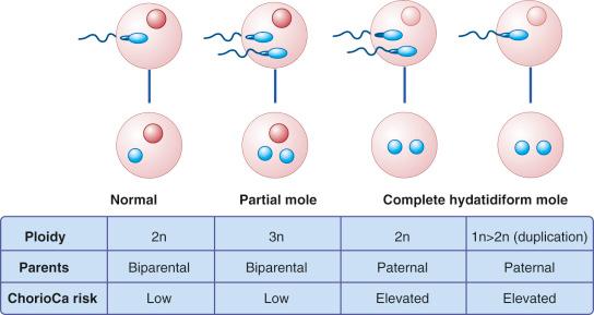 Fig. 30.1, Pathogenesis of trophoblastic neoplasia, including partial and complete mole. ChorioCa, Choriocarcinoma.