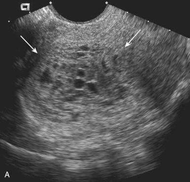 Fig. 30.3, A, Sonographic findings in complete mole. Transverse image of the uterus demonstrating a complex mass (arrows) filling the uterine cavity. The mass has solid components and small cystic areas, characteristic of a complete hydatidiform mole (CHM). B, Complete mole as seen through the dissecting microscope. Note the diffuse grapelike villous swelling.