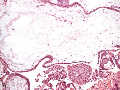 Fig. 30.4, Histologic features of complete mole. A, Large swollen villi with necrosis of the mesenchyme producing central cavitations (cisterns). B and C, Conspicuous, concentric cytotrophoblastic and syncytiotrophoblastic hyperplasia. D, Atypical implantation site.