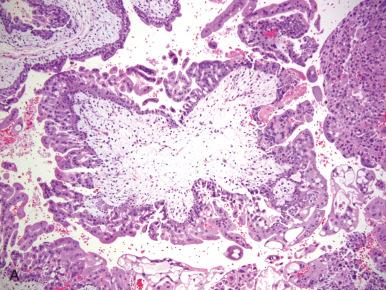 Fig. 30.5, Features of early complete hydatidiform mole (CHM). A, Moderately enlarged villi; cisterns are not prominent, but the concentrically arranged trophoblastic hyperplasia is conspicuous. B, Hypercellular, “fibroadenoma-like” villous stroma with a bluish appearance caused by immature fibroblasts. C, Characteristic irregular villous contours resembling knuckles or toes. D, The implantation site trophoblast is often the most conspicuous trophoblastic atypia in early complete mole.