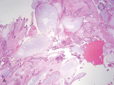 Fig. 30.6, Degenerating early complete hydatidiform mole (CHM). A and B, This entity can be challenging because it may mimic a hydropic abortus and the trophoblastic proliferation can be less conspicuous. B, Note the cistern in the center and the slight accentuation of the trophoblast. Cases such as this are often resolved by immunostaining for p57 KIP2 ; however, if the tissue is poorly preserved, the immunostain may be falsely negative.