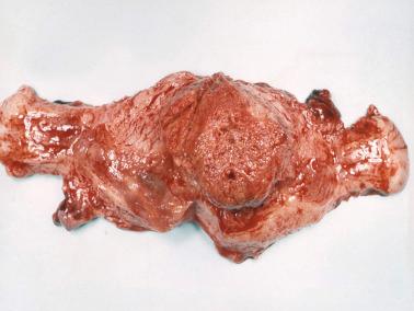 Fig. 10.11, Choriocarcinoma. A polypoid hemorrhagic mass involves most of the endometrial cavity.