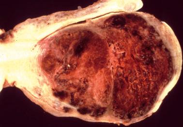 Fig. 10.12, Choriocarcinoma. A hemorrhagic mass expands and replaces the uterine wall.
