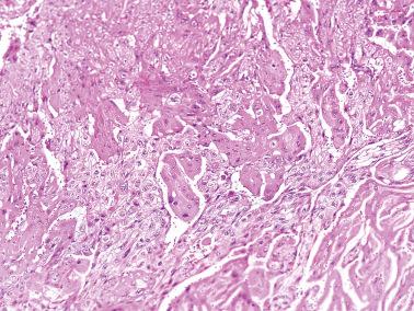 Fig. 10.13, Choriocarcinoma. Classic biphasic appearance with numerous multinucleated trophoblastic giant cells separated by mononucleate cytotrophoblast.