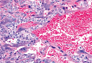 Fig. 10.14, Choriocarcinoma. Note typical admixture of cytotrophoblast and syncytiotrophoblast and focal hemorrhage.