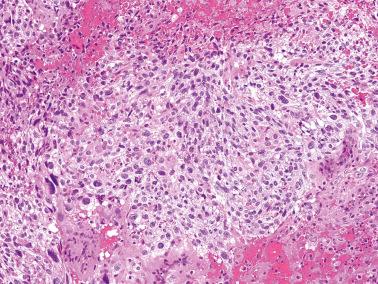 Fig. 10.15, Choriocarcinoma. Predominantly so-called monophasic pattern, represented by almost exclusive component of cytotrophoblast with only rare questionable cytotrophoblastic giant cells.