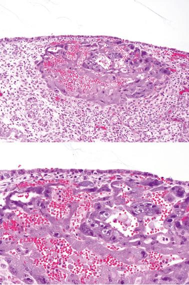 Fig. 10.16, Trophoblast of an early gestation. The ‘atypical’ cytologic features (bottom) may cause concern for choriocarcinoma.