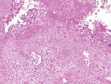 Fig. 10.17, Normal intermediate trophoblast. A confluent growth of intermediate trophoblast whose cells have typical abundant amphophilic cytoplasm is seen. Two foci of cytotrophoblast are also seen at the top left and right.