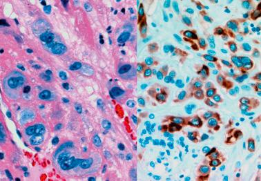 Fig. 10.18, Normal intermediate trophoblast (IT). Left: In contrast to the admixed decidual cells (lower right corner), the nuclei of the IT are larger, more irregular, more hyperchromatic, and exhibit multinucleation. Right: Cytokeratin stain showing immunoreactive IT cells with negative staining in the background decidual cells.