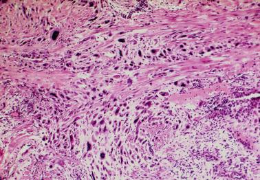 Fig. 10.19, Exaggerated placental site. There is striking involvement of the myometrium by intermediate trophoblast.