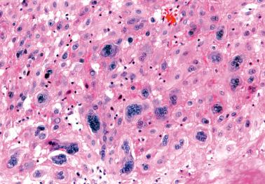 Fig. 10.20, Exaggerated placental site. Many multinucleated intermediate trophoblastic cells are present.