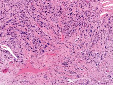 Fig. 10.21, Exaggerated placental site. The confluence of the proliferation in most of the image can lead to a misinterpretation of malignancy.