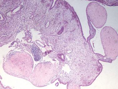 Fig. 10.22, Placental site nodules. This benign process can be multifocal.