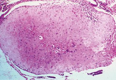 Fig. 10.23, Placental site nodule. Note well-circumscribed border and extensive hyalinization.