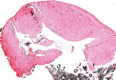 Fig. 10.24, Placental site plaque found in a curettage specimen.