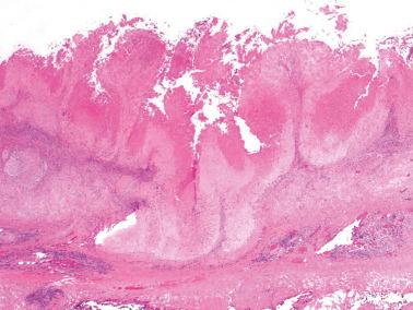 Fig. 10.25, Placental site plaque. A band like proliferation of intermediate trophoblast is seen coating the lower uterine segment.