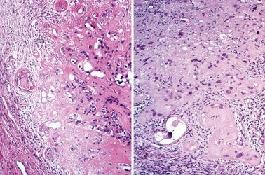 Fig. 10.26, Placental site nodule. The periphery of the lesions may show pseudopod-like extensions that can suggest infiltration.