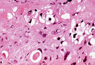 Fig. 10.27, Placental site nodule. The trophoblastic cells contain cytoplasmic vacuoles, eosinophilic hyaline bodies, and have hyperchromatic nuclei that vary considerably in size and shape.