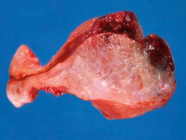 Fig. 10.28, Placental site trophoblastic tumor. The neoplasm is partially hemorrhagic but also contains a yellow ill-defined component which blends into the adjacent myometrium.