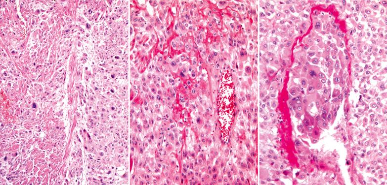 Fig. 10.29, Placental site trophoblastic tumor. Left: Sheets and clusters of tumor cells with typical abundant amphophilic cytoplasm invade myometrial smooth muscle. Center: The tumor cells are focally separated by fibrinoid deposits. Right: The tumor cells fill the lumen of a myometrial vessel, the wall of which has been replaced by fibrin.